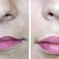 Увеличение губ  в клинике Dr. Lang Esthetics